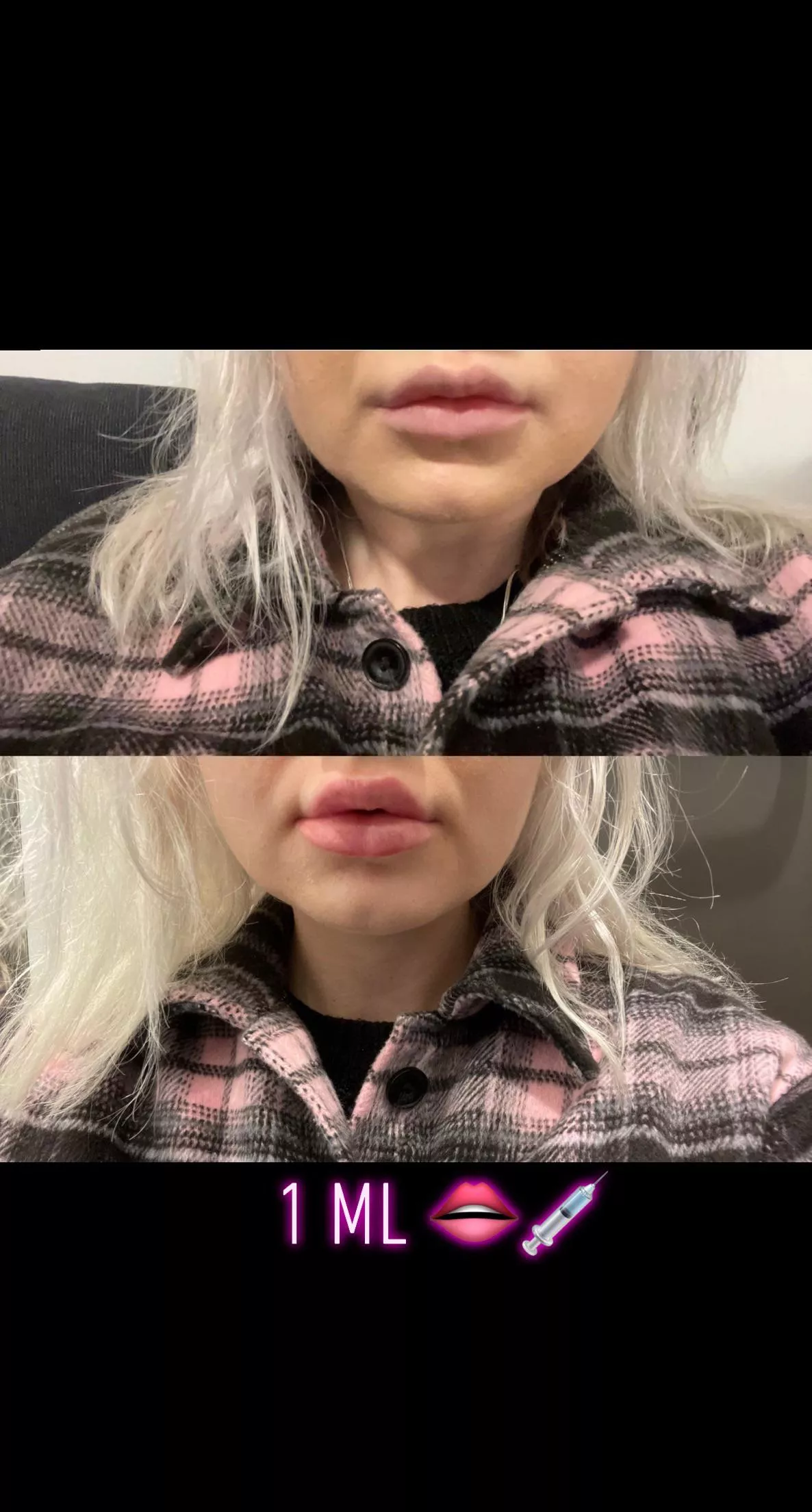 1 ml 💉 Getting those DSL lips👄 1 ml 💉 Getting those DSL lips👄