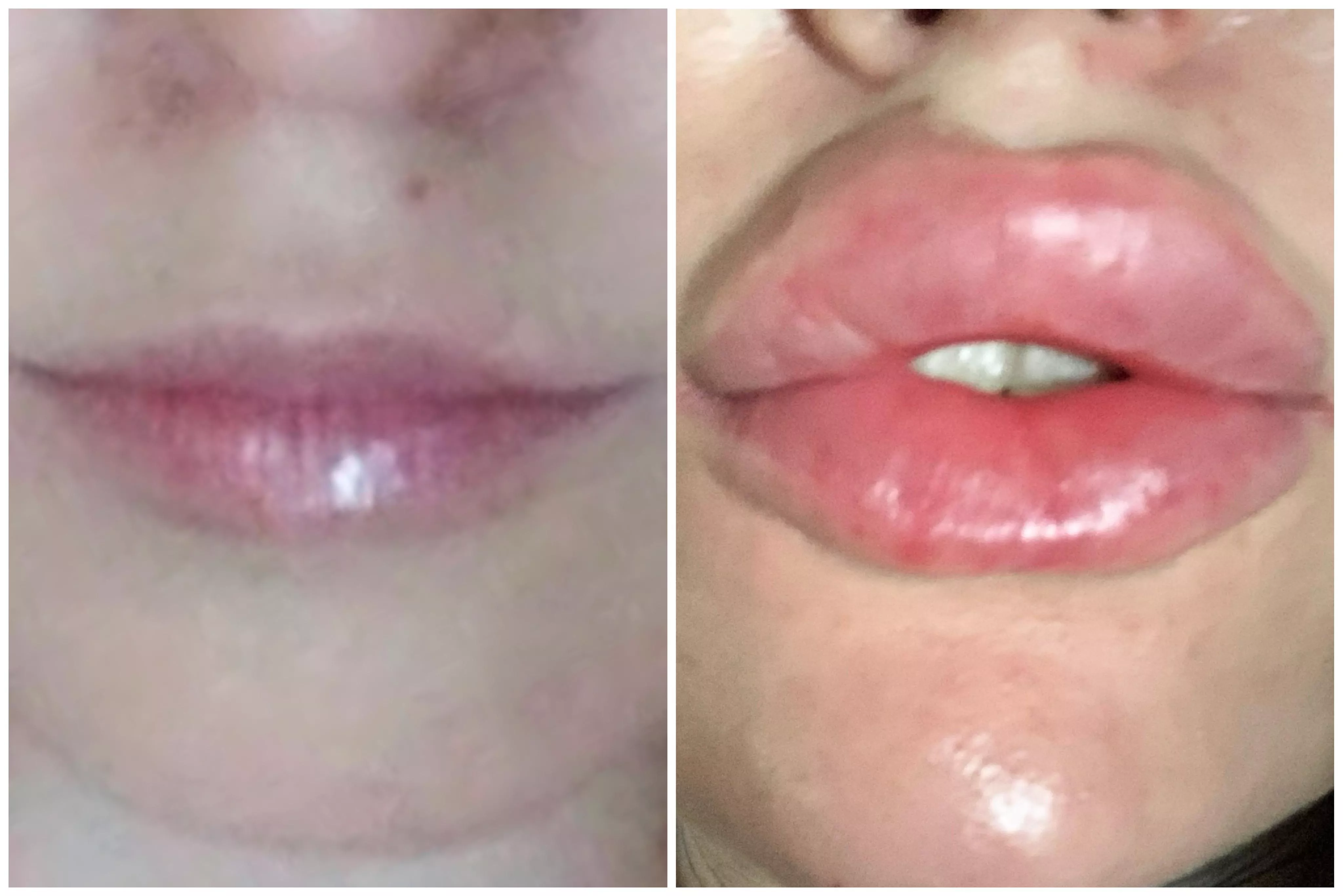 2017-2022 💋 Freshly injected today, very swollen 💋