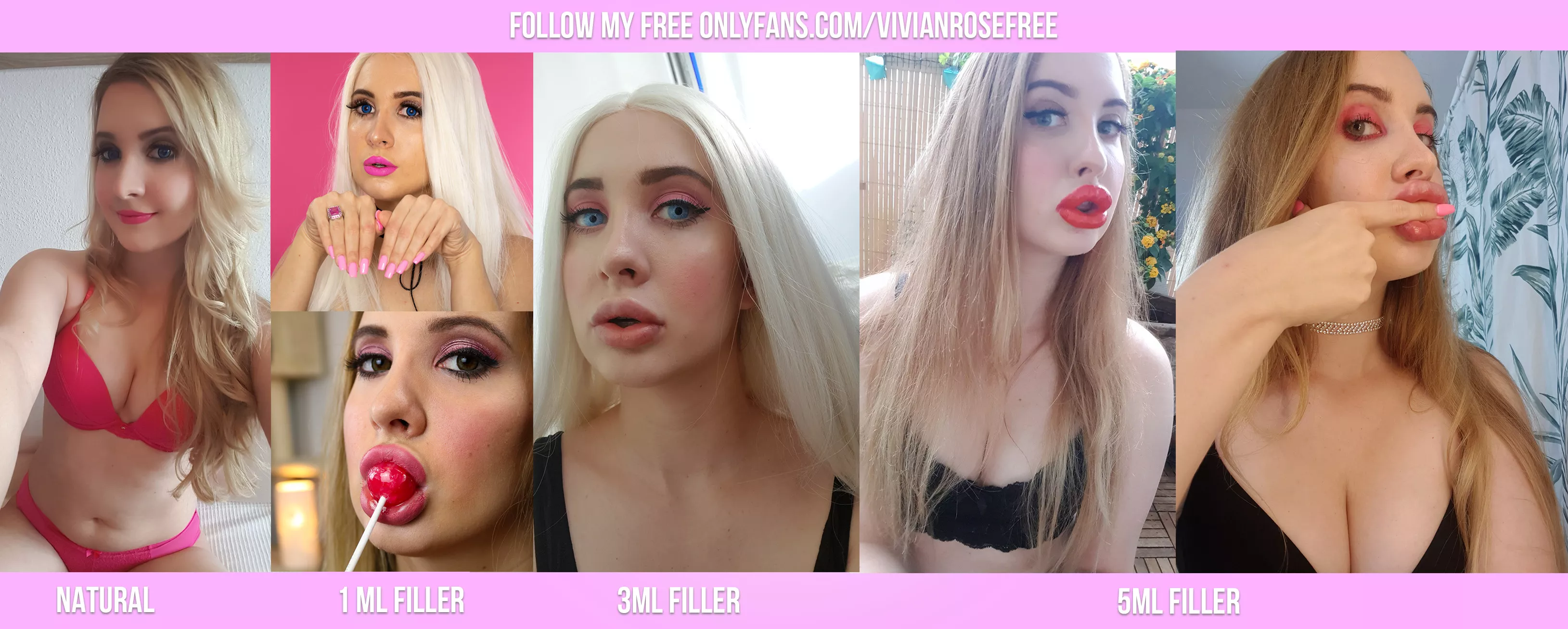 5ml in so far. Going blonder soon, should I go even bigger as well? [3 Year Transformation]???