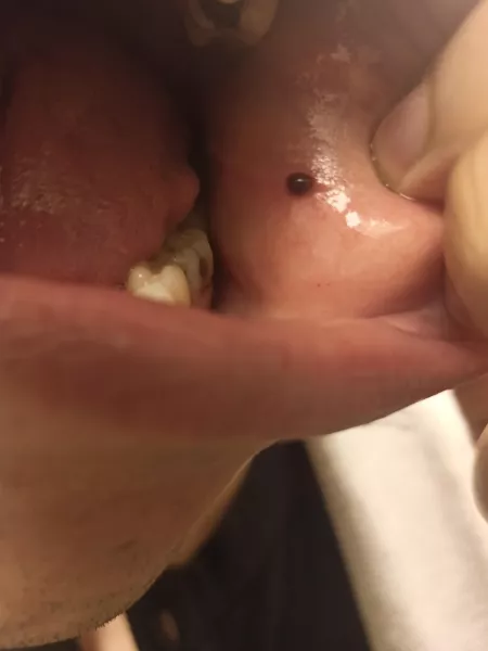 A blood blister in my cheek, should i pop?