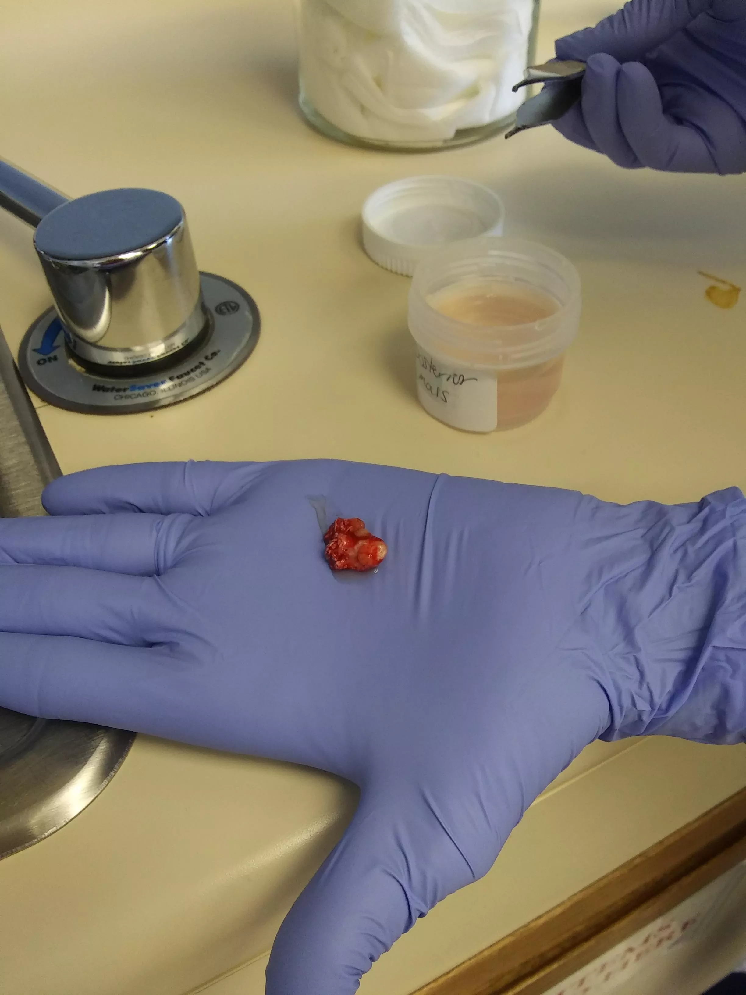 A cyst that was removed from my neck