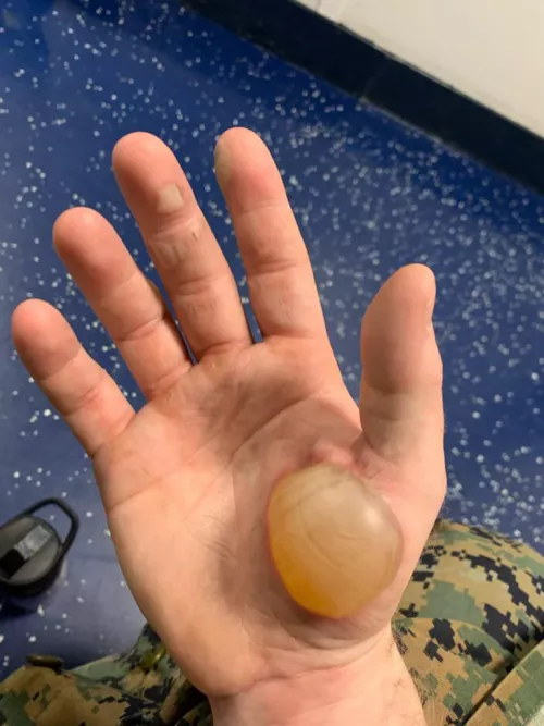 A most forbidden pop (cared for by surgeon, healed now)