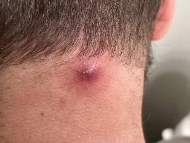 Angry boi on my neck from a year old cyst