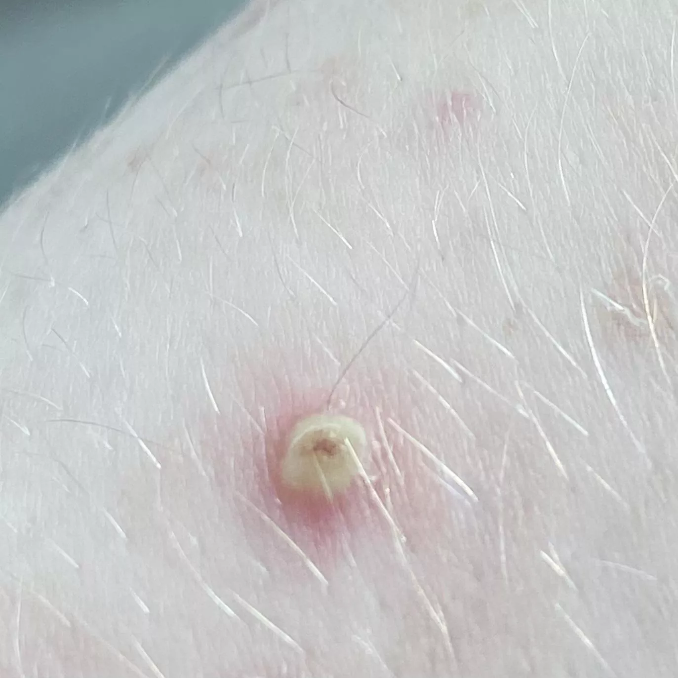 angry keratosis pilaris after popping a day before (sorry i don’t have a video, but you know it’s a good one when it’s yellow lol, had to share)