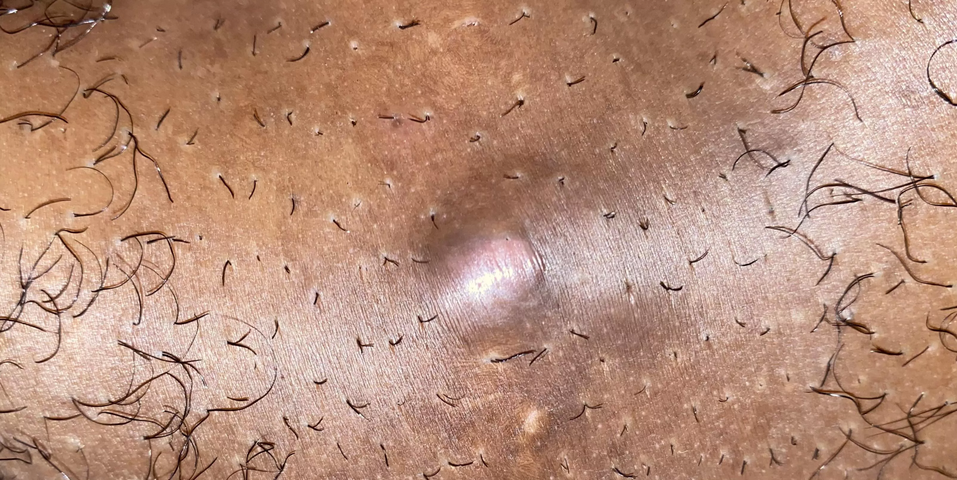 Anybody have any idea what this could be? Thought it was an ingrown hair but I pulled small ones out and its still here. Maybe a cyst? In genital area.