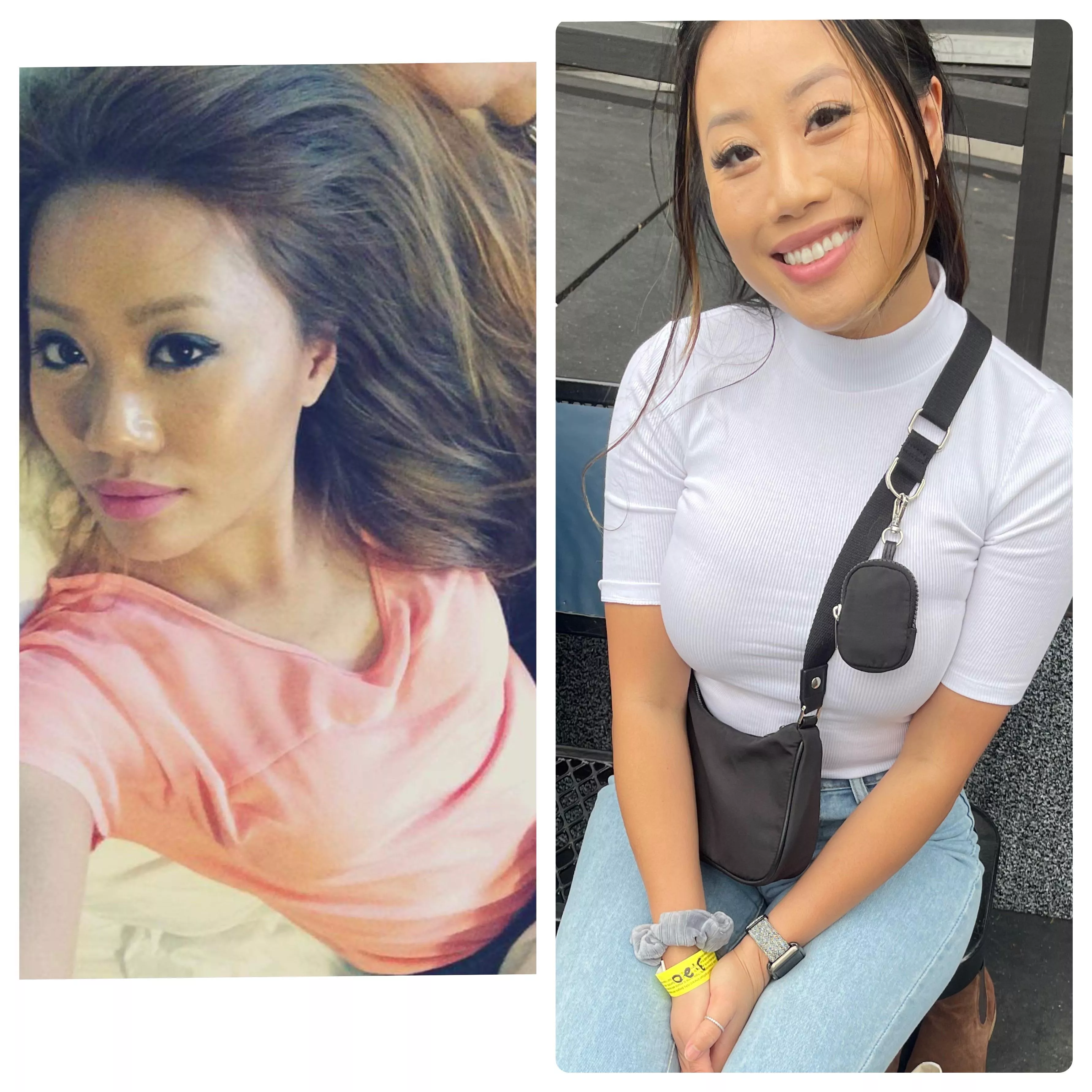 Asian breast growth 32A to 32F