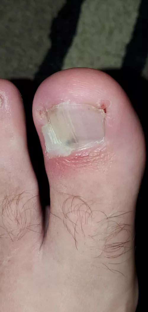 Been in pain for over a week, finally decided to soak my foot and see if I could pull this ingrown nail out... This was the aftermath. Instant relief with some puss and blood.