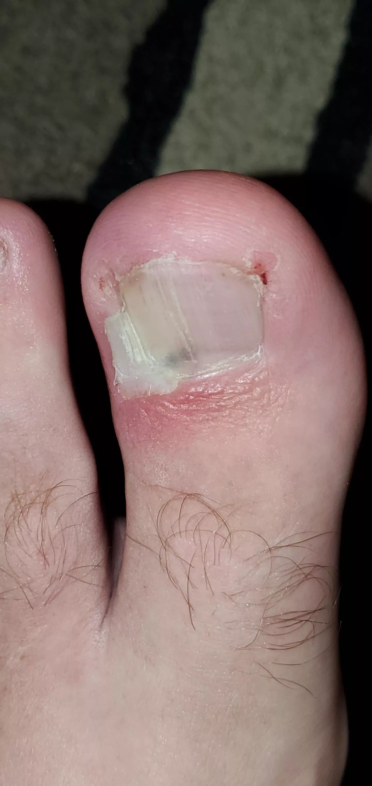 Been in pain for over a week, finally decided to soak my foot and see if I could pull this ingrown nail out... This was the aftermath. Instant relief with some puss and blood.