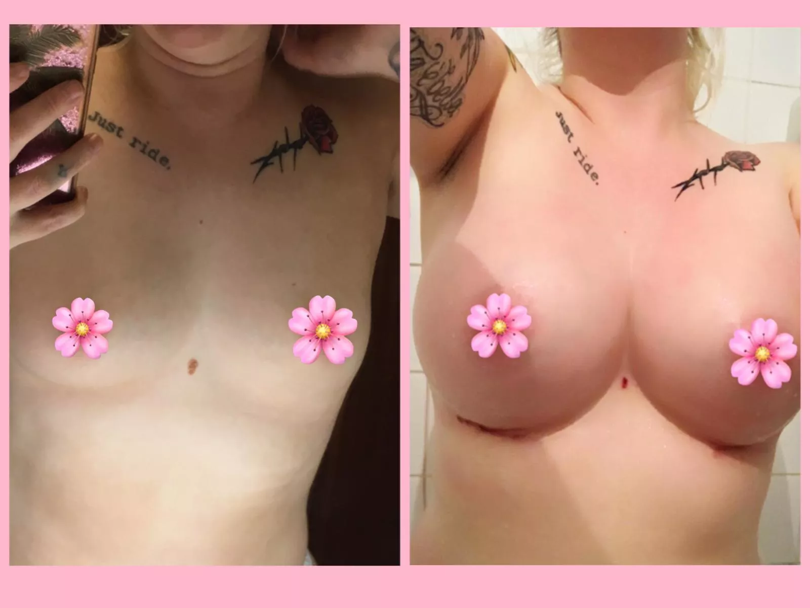 Before and 10 days psot op Before and 10 days psot op