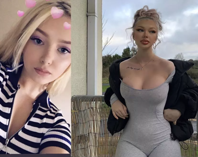 Before and after , the lip fillers really made me 100 times hotter Before and after , the lip fillers really made me 100 times hotter