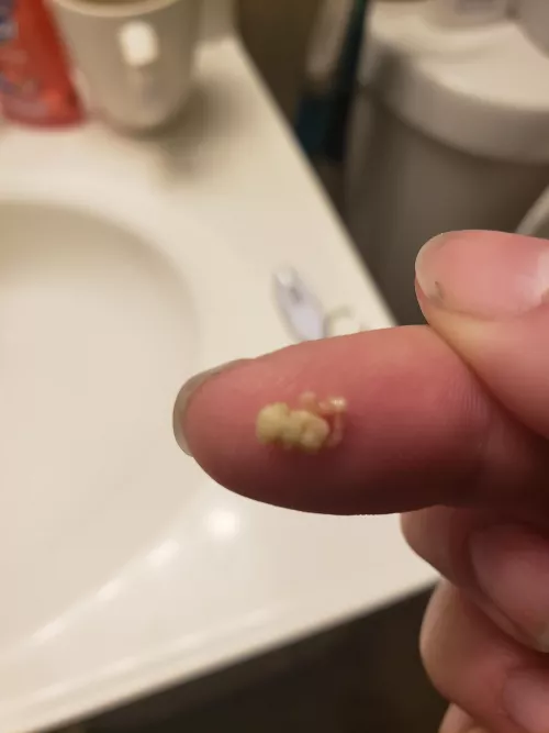 Before this sub I didn't even know tonsil stones were a thing..today, I pulled this out.
