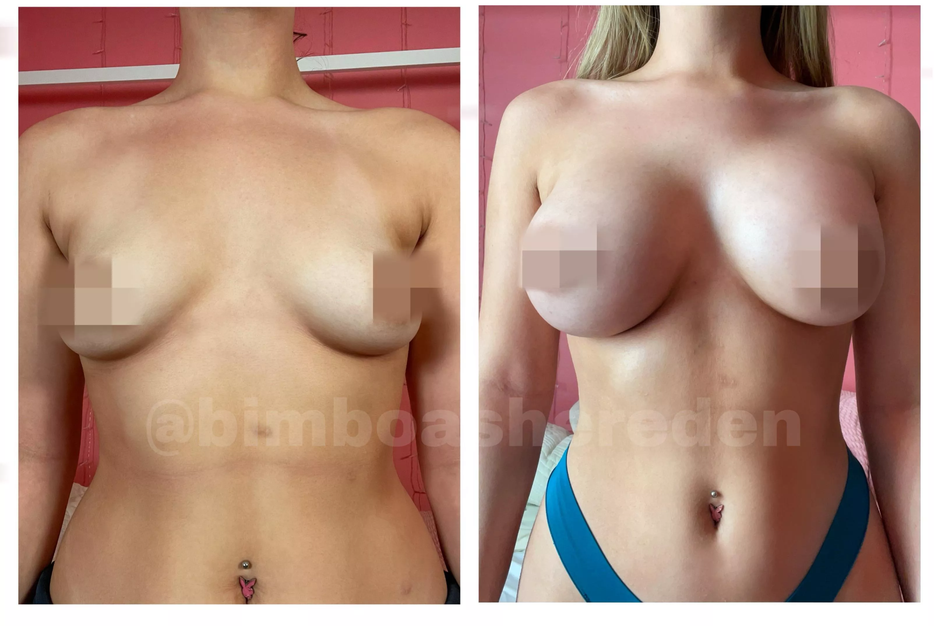 Before/After Boob Job (My Pic, Watermark is Twitter Username!)