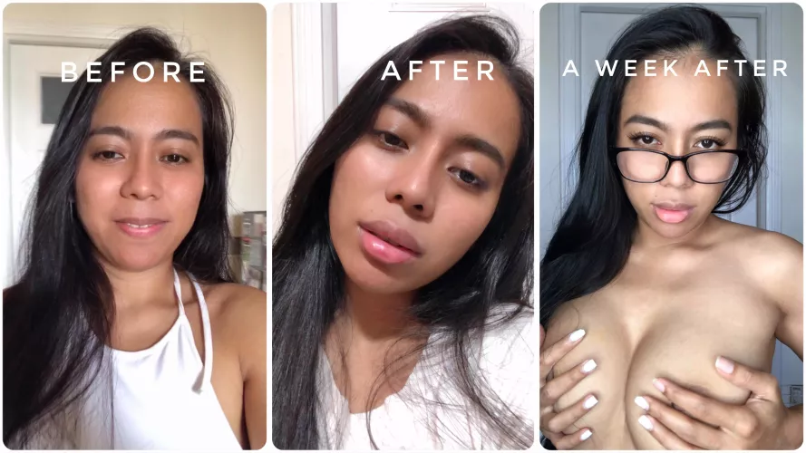 Bimbo journey update: A generous supporter funded my first ever round of lip fillers! Iโm sooo over the moon!! ๐๐ฅฐ๐How do I look? ;)