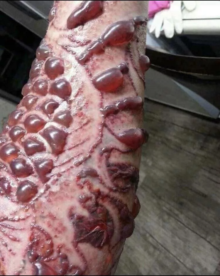 Blisters following laser treatment to remove tattoos. Not me, found in FB tattoo group.