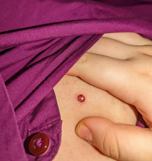 Bloody twat popped while I was adjusting my camera to record; stained my favorite button up with blood. Still wanted to share this dickface of a zit