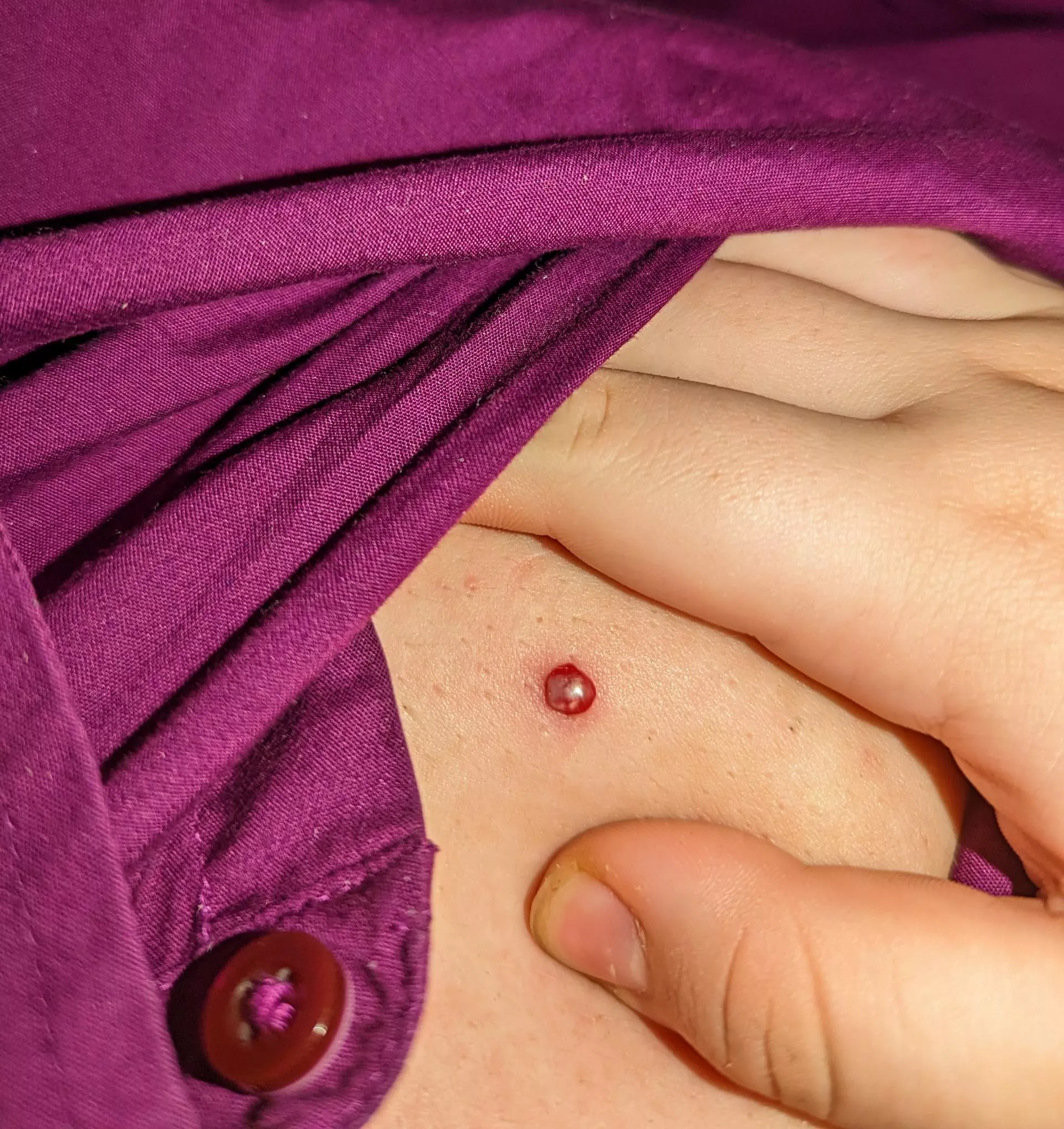 Bloody twat popped while I was adjusting my camera to record; stained my favorite button up with blood. Still wanted to share this dickface of a zit