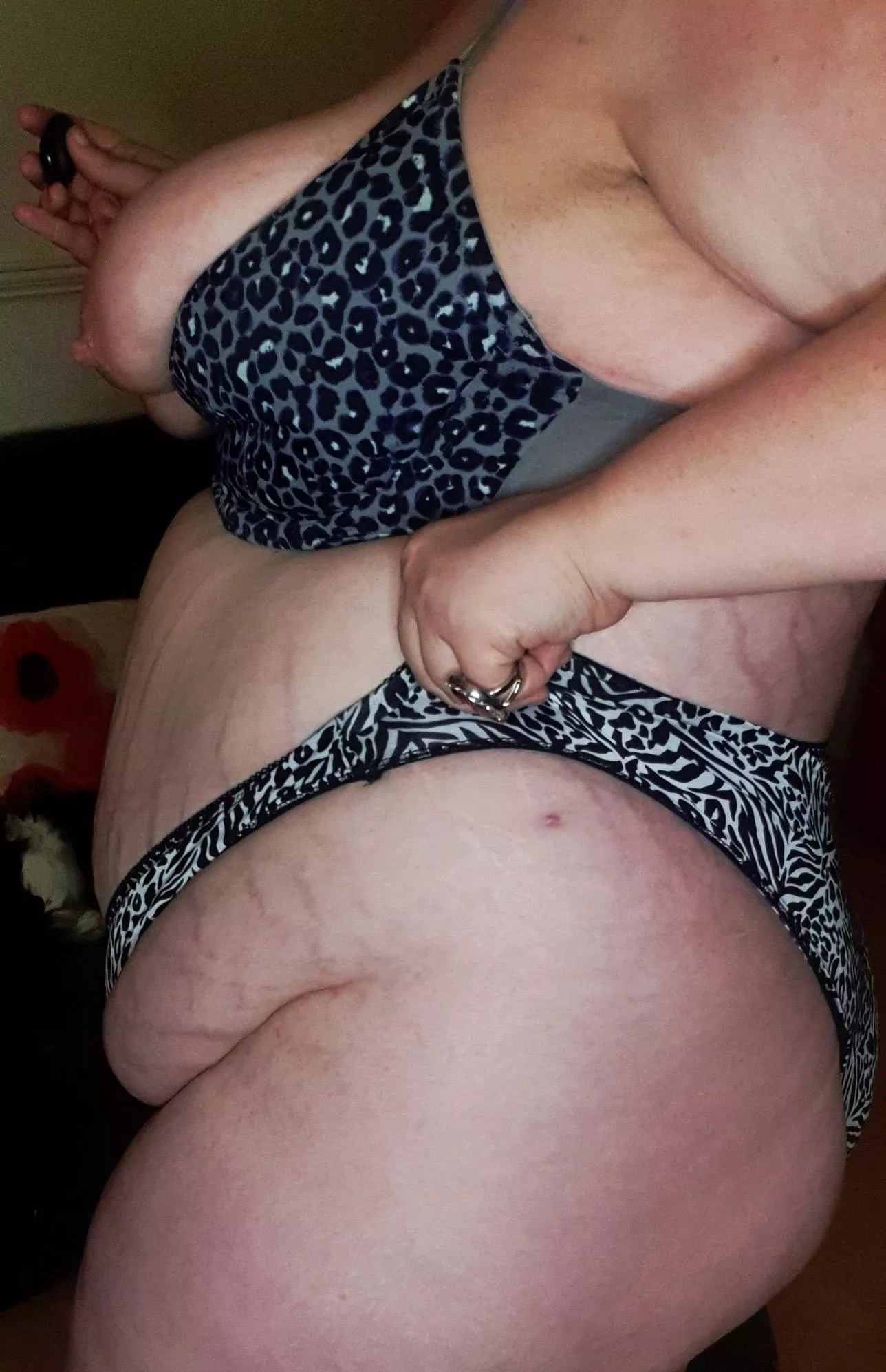 Cellulite and stretchmarks