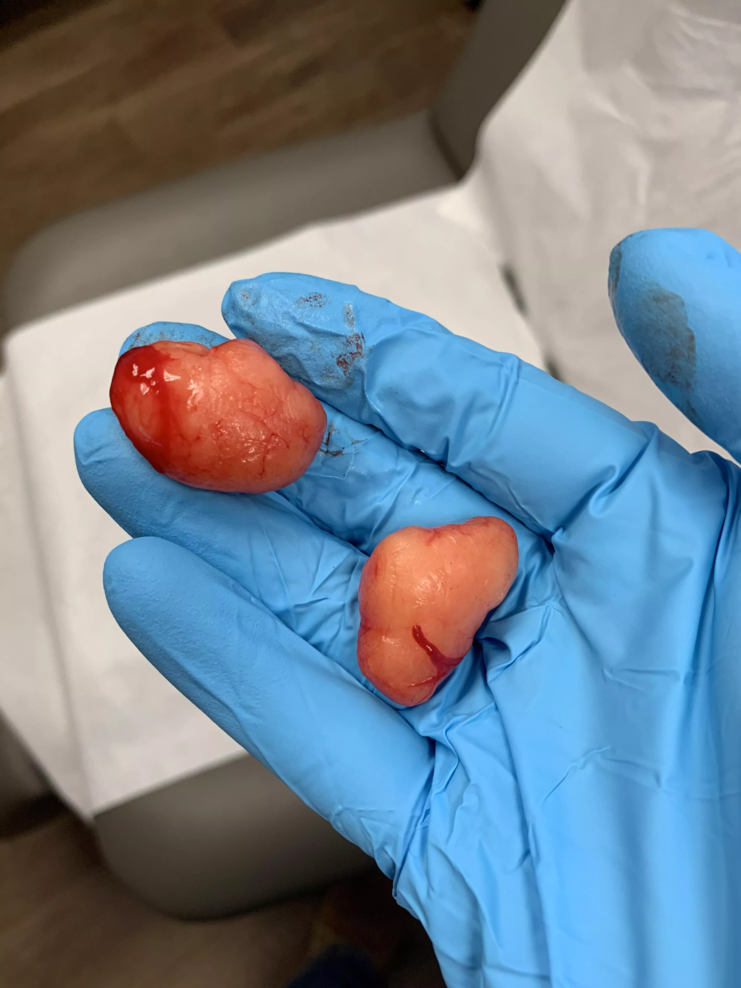 Couple lipomas from my chest