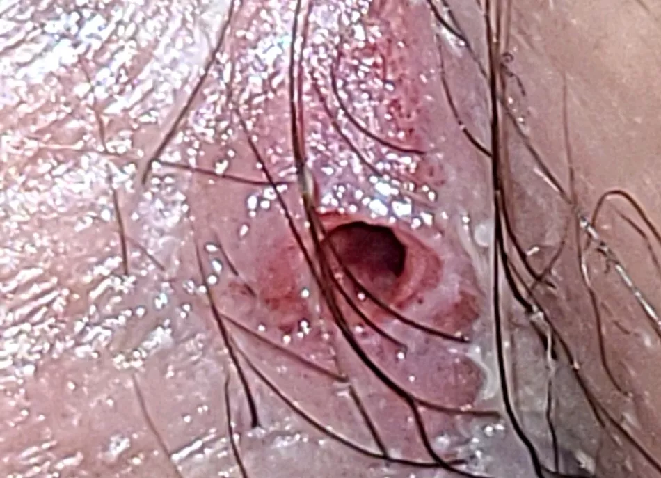 Decade old pilonidal cyst ruptured in my sleep...