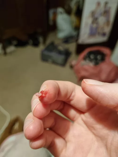 Deep verruca root I just pulled out my foot. More info in the comments