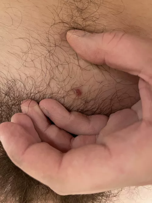 Does anyone know what this is, and how I could remove it? Got it a couple of years ago after shaving.