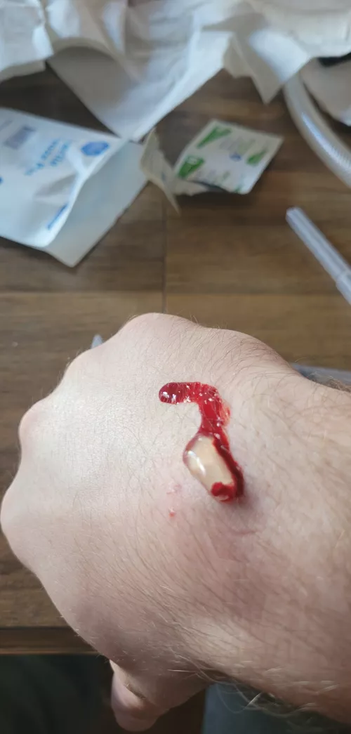 Drained the ganglion cyst on my wrist. Nobody could stomach filming it so here's the aftermath
