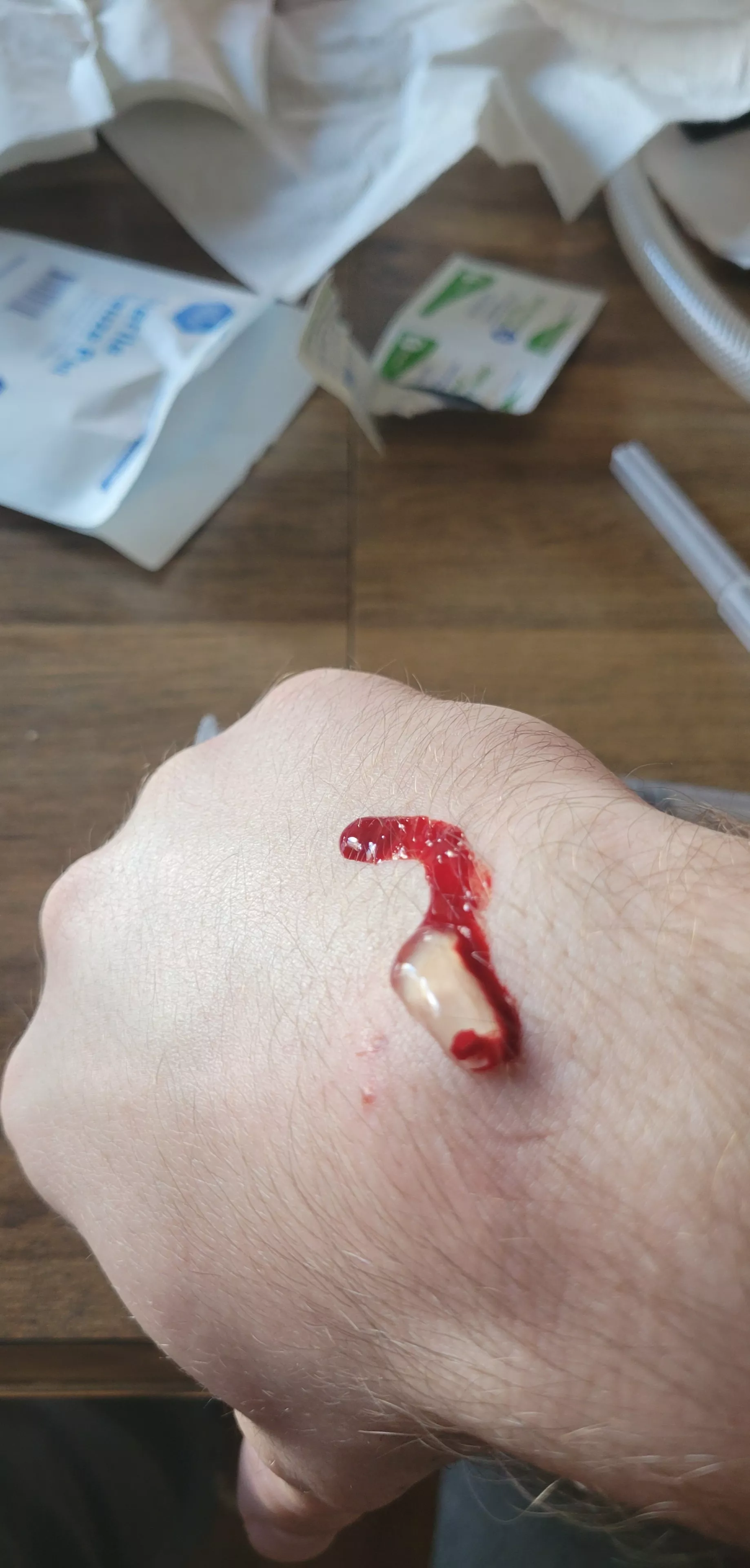 Drained the ganglion cyst on my wrist. Nobody could stomach filming it so here's the aftermath
