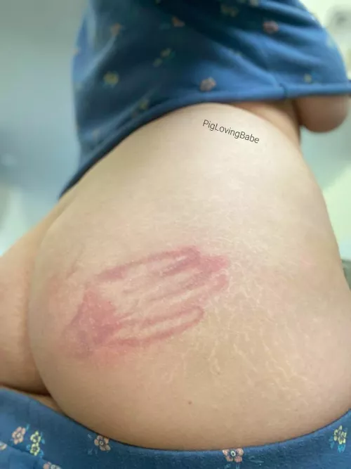 [F] Other Cheek Needs One Too!