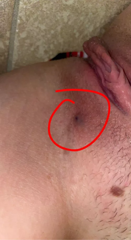 f19 5’5 120lb does anybody know what this is? i’ve been tested and i know im clean but this bump hurts and just won’t go away :/