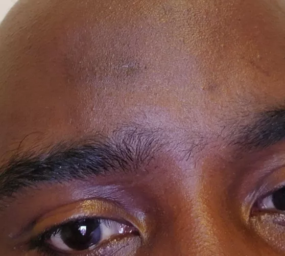 Followup to earlier post. Healing progress