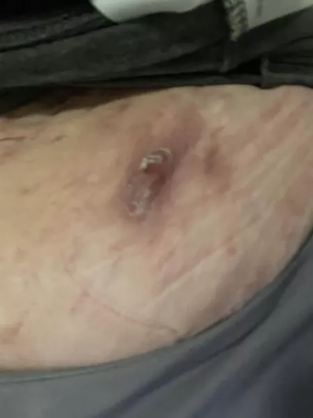 For y’all asking to see the aftermath of my bloody fingers the other day, here ya go. HS (hidradenitis suppurativa) is MISERABLE y’all.😫