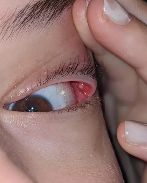 forbidden pop- 4 day old internal stye. i hope to god it goes away soon.