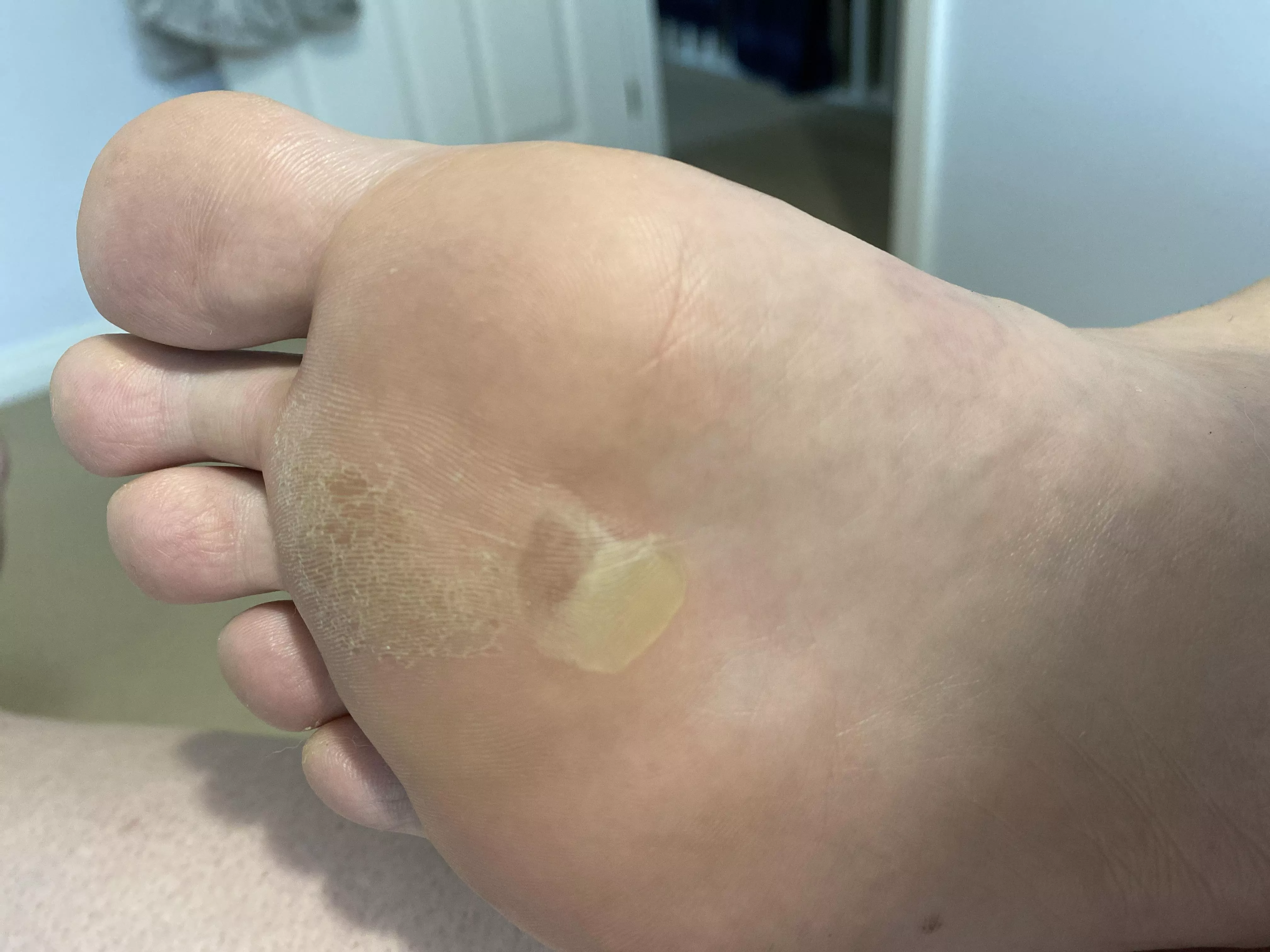 Forbidden pop - blister on a blister on my foot. Sucker hurts like hell!
