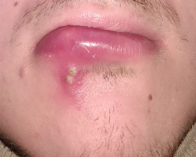 Forbidden pop: dunno yet what caused the swollen lip, what is for sure that i would love to pop that...