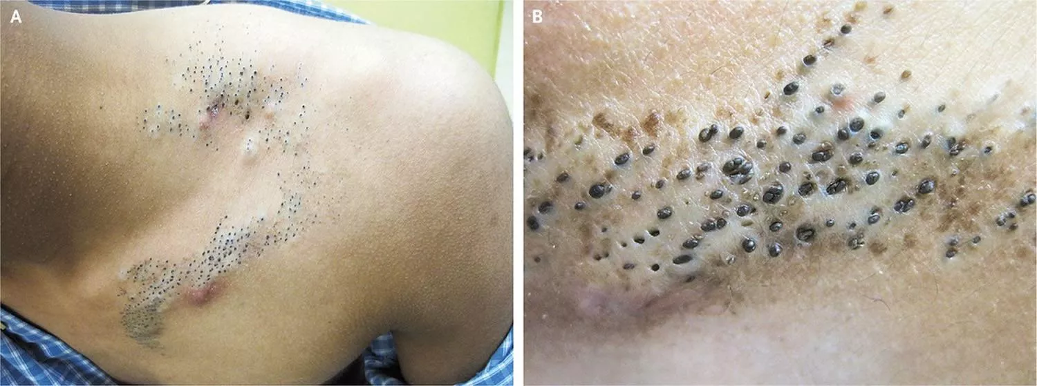 Found in /trypophobia ... Would love to see these extracted