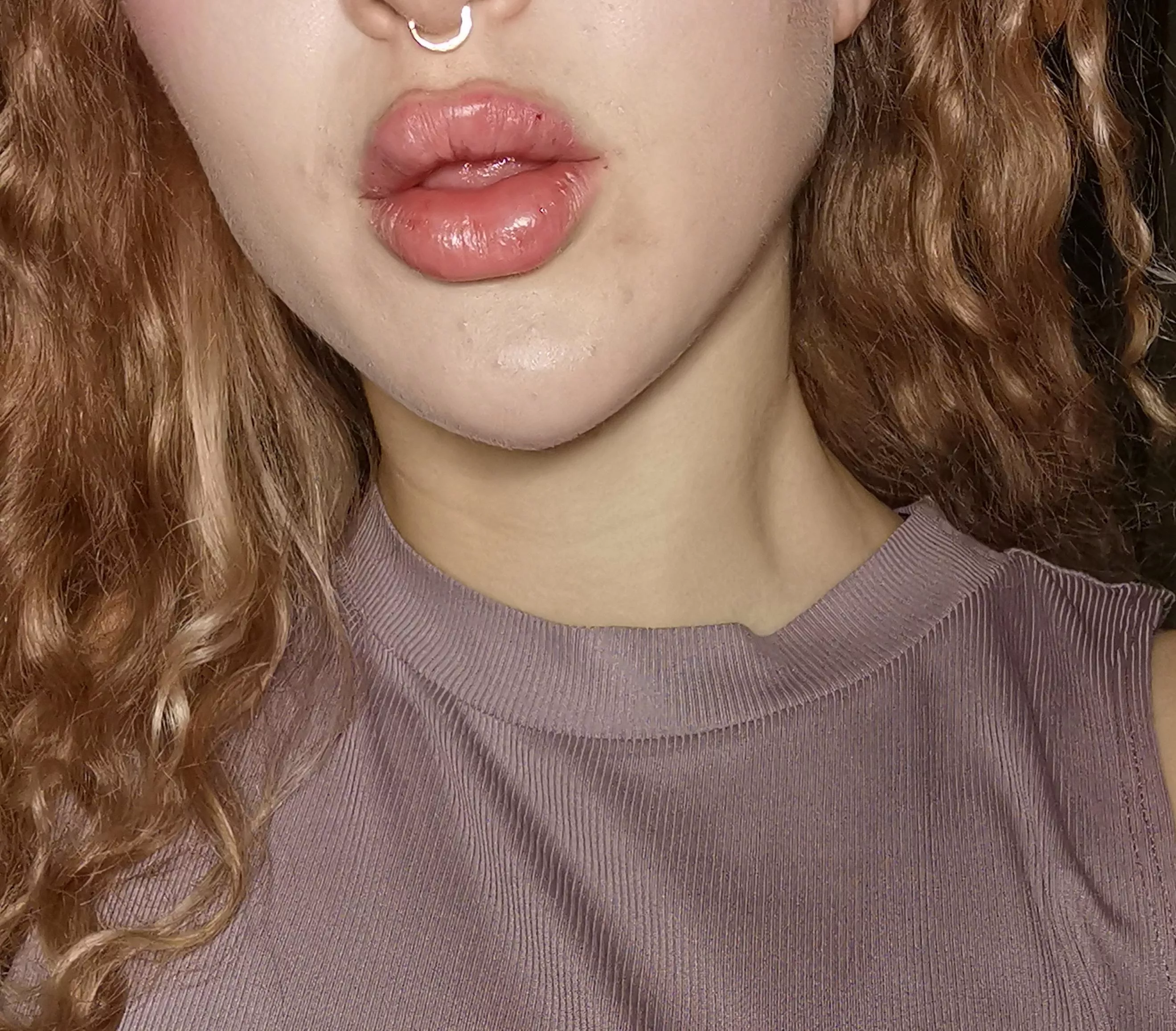 Freshly done lip fillers (there're still some scabs at the injection points) - literally the best feeling ever