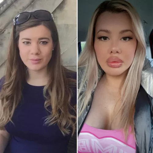 👄💉Fuck Dolly lips are stuffed! Yesterday I had 1ml pumped into them taking my fill levels to 1.8ml 🤤. As well as this my face is almost completely frozen now with Botox and at the beginning of February I hope get my 520cc dolly tits stretched ou