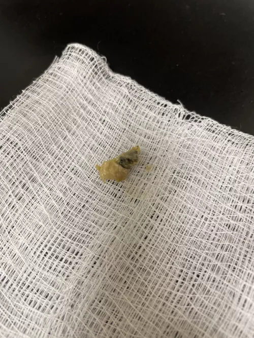 Fungal and pus plug extracted from my ear. Infections suck.