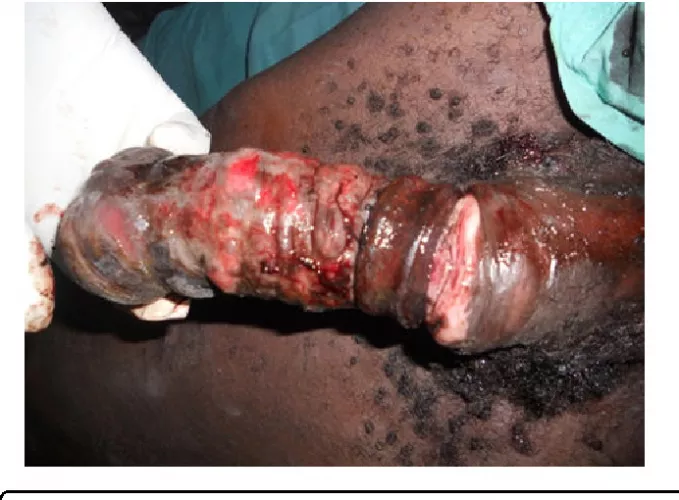 Gangrene of the Penis due to Strangulation by a Metallic Ring: A Case Report