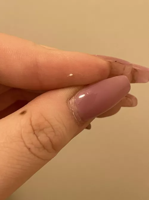 Got a milia, was so nice to finally get it out.