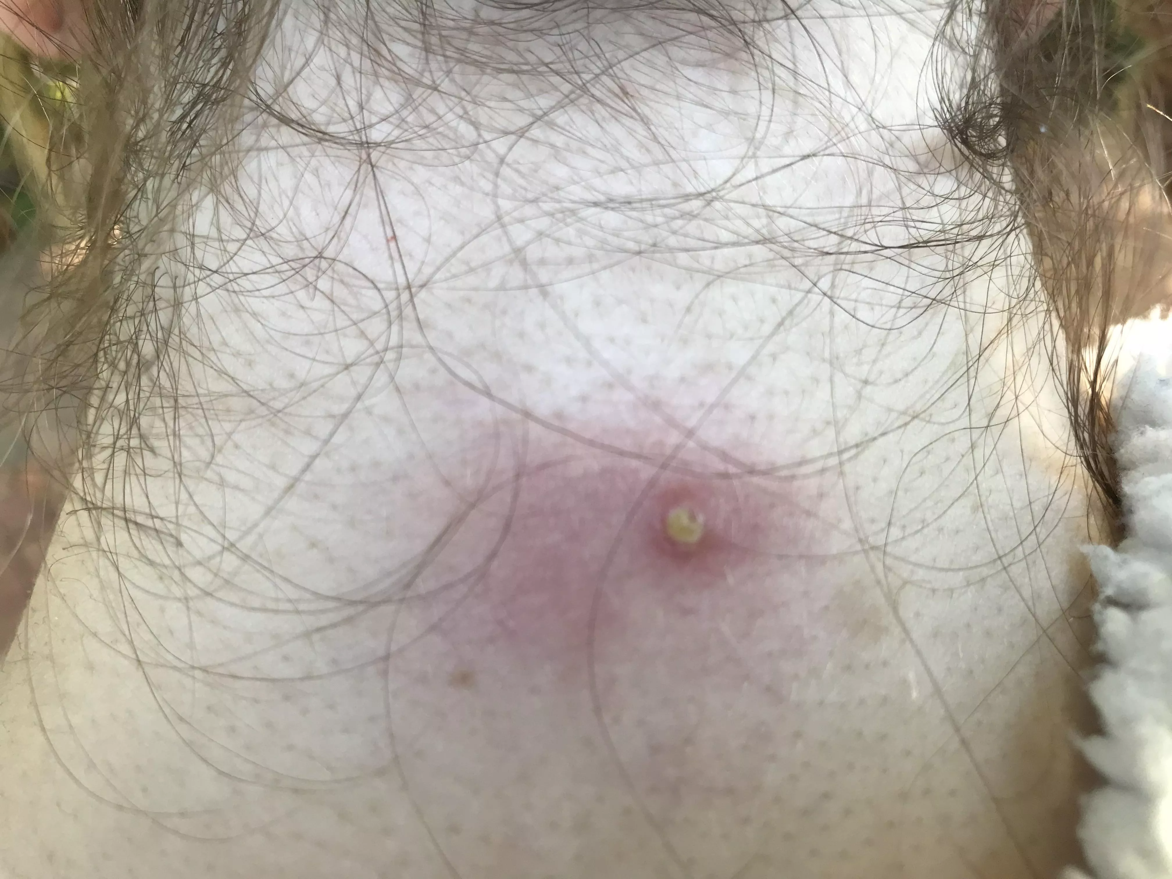 Got this cyst on the back of my neck that keeps growing and shrinking on its own and usually resolves itself but this time it is ANGRY. Must resist the urge to stab it