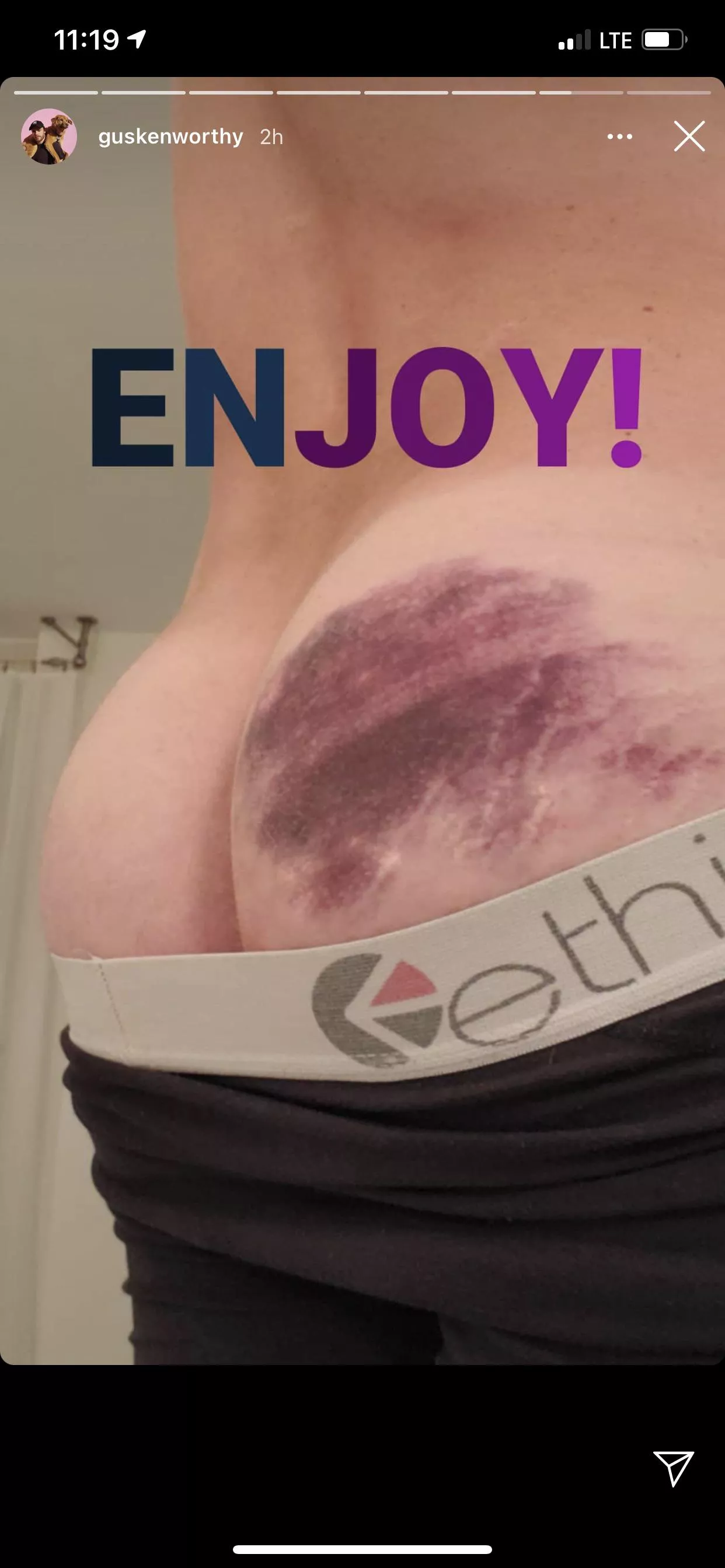 Gus Kensworthy via Instagram Story (Bruised Butt)