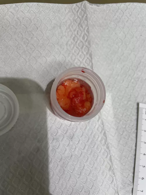 Had a lipoma removed today. Three total in one spot. He just kept digging.