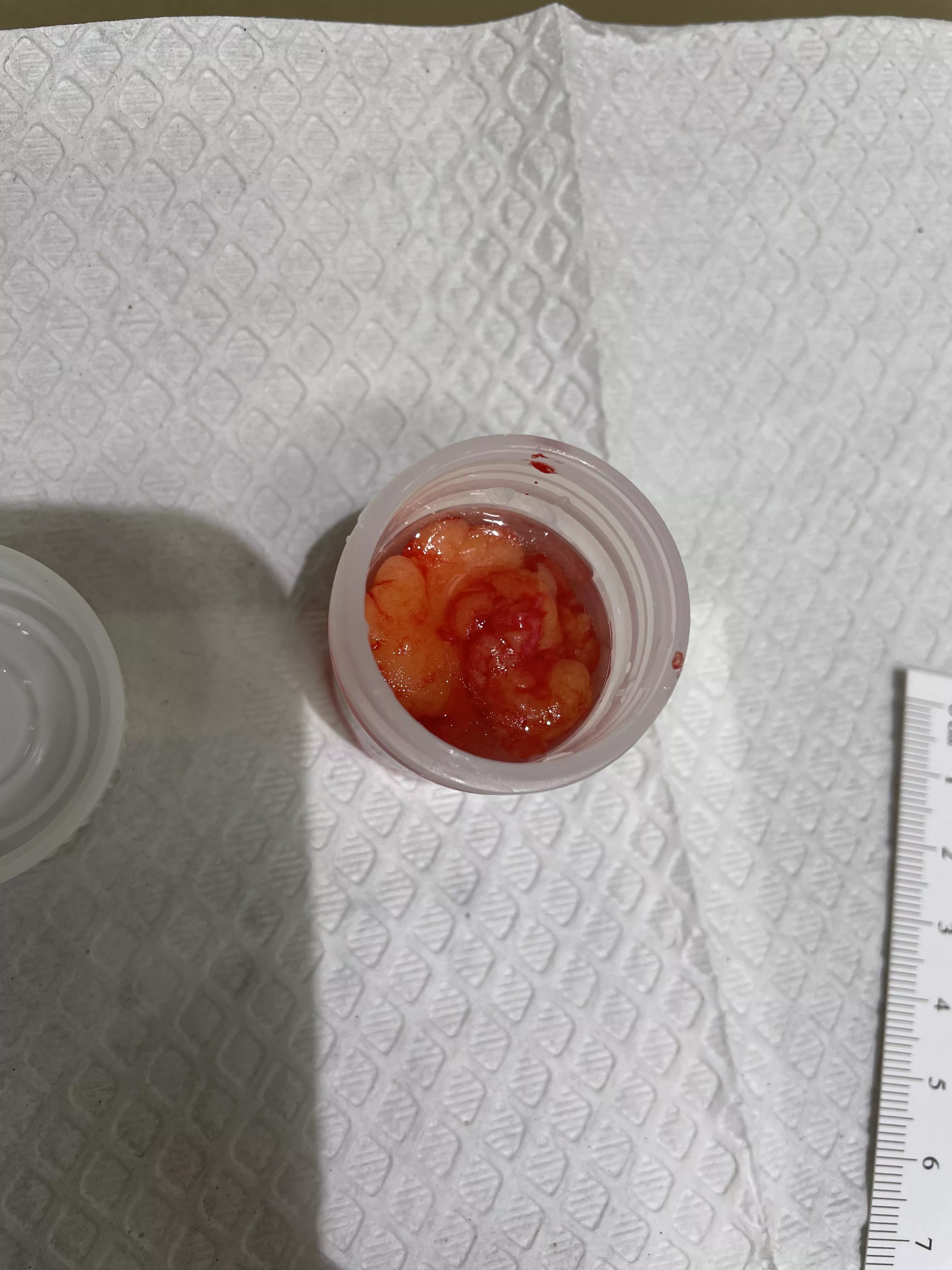 Had a lipoma removed today. Three total in one spot. He just kept digging.