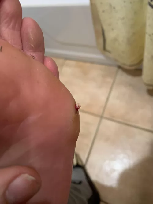 Had an infection in my foot, this was the last pop that made me able to walk pain free again