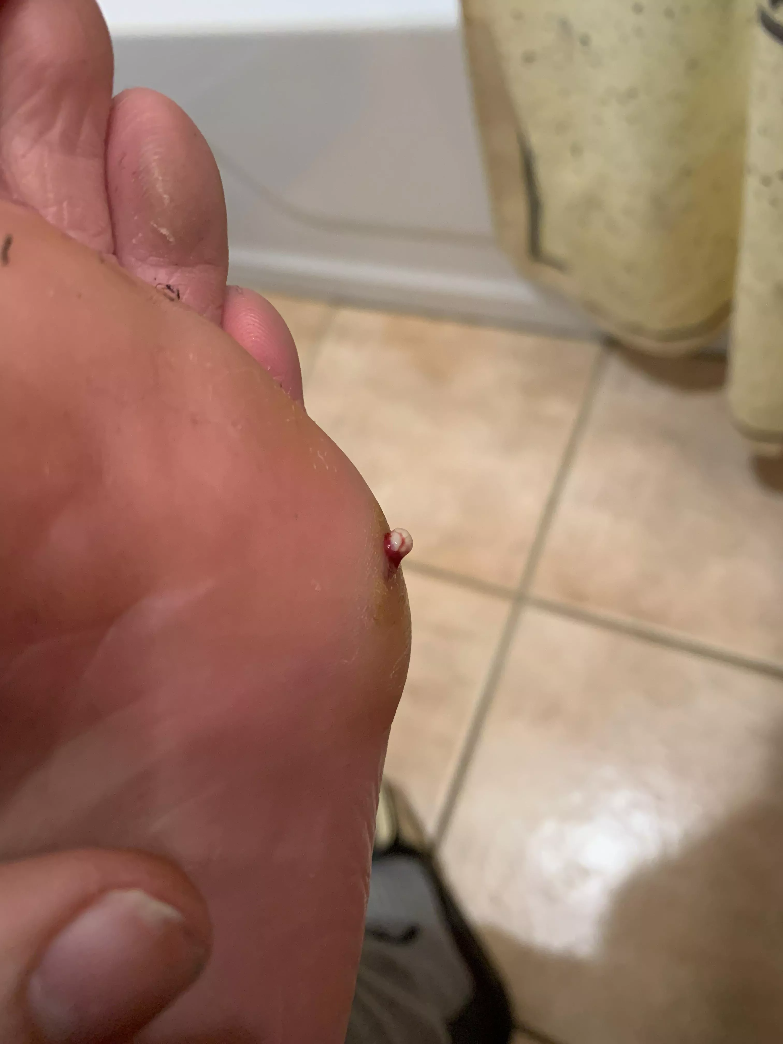 Had an infection in my foot, this was the last pop that made me able to walk pain free again
