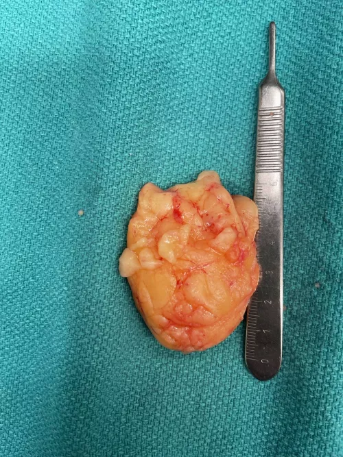 Had this big Bertha removed today. Wish I had it on video. It was in there good.