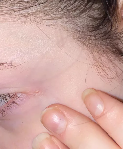 had this for about a decade now. it hurts too much to pop but the urge has been quite strong lately