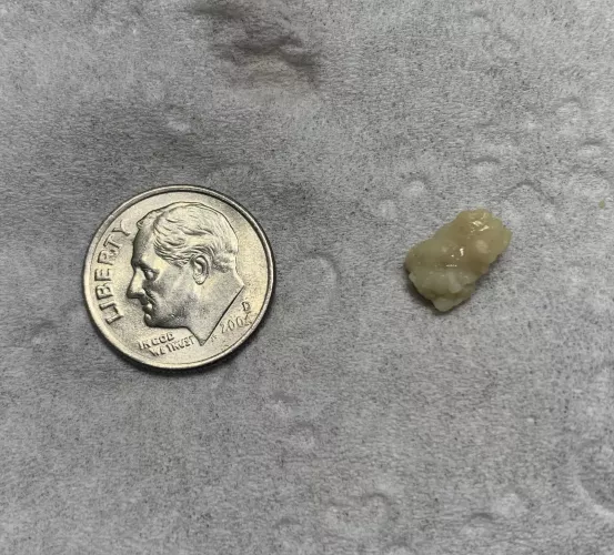 Huge tonsil stone I removed from my throat (from COVID-19)