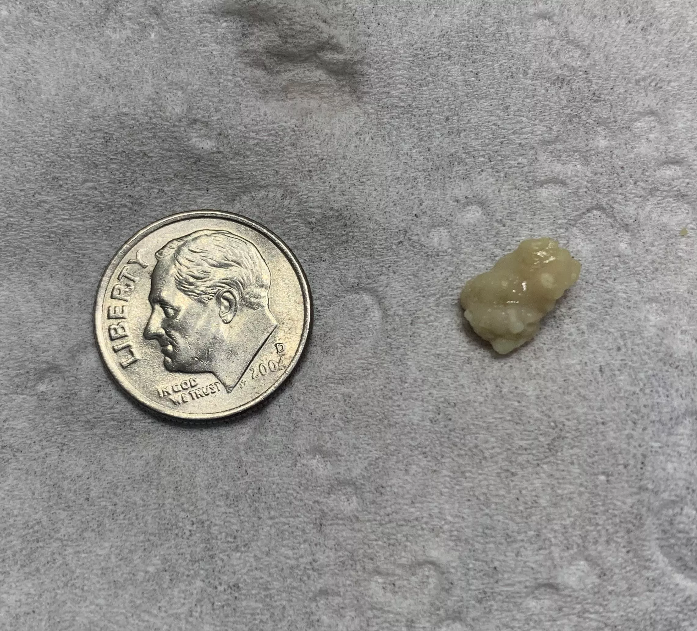 Huge tonsil stone I removed from my throat (from COVID-19)
